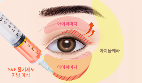 티타늄